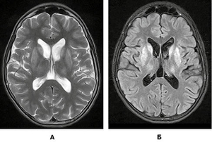 Рисунок 1. Типові ознаки гепатоцеребральної дегенерації на МР-томограмах головного мозку в режимах Т2 (А) і Т2/Flair (Б)