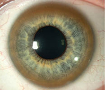 Рисунок 4. Кільце Кайзера–Флейшера — офтальмологічна ознака хвороби Вільсона