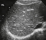 Рисунок 5. Результати УЗ-дослідження печінки пацієнта